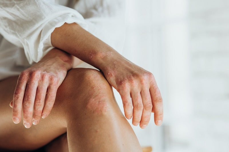 Salt therapy and skin conditions: psoriasis and eczema
