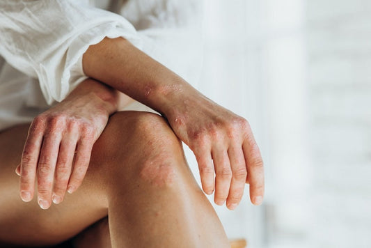 Salt therapy and skin conditions: psoriasis and eczema